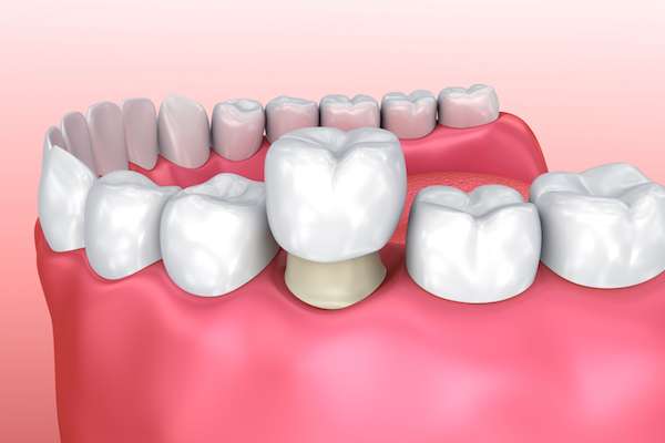 What are the benefits and types of undergoing temporary tooth bridges?